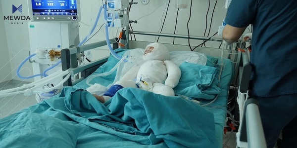 تەندروستیی سلێمانی: لە مانگێکدا 256 حاڵەتی سووتاوی تۆماركراوە