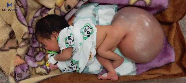 نەشتەرگەری بۆ منداڵە ناسروشتییەکەی هەڵەبجە ئەنجامدرا