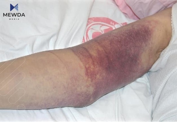 حاڵەتێکی دیکەی تای خوێنبەربوون تۆمارکرا