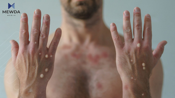 له‌ كوردستان 87 تووشبووى ئایدز تۆمارکراون